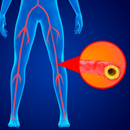 Arteriopatia obliterante arti inferiori