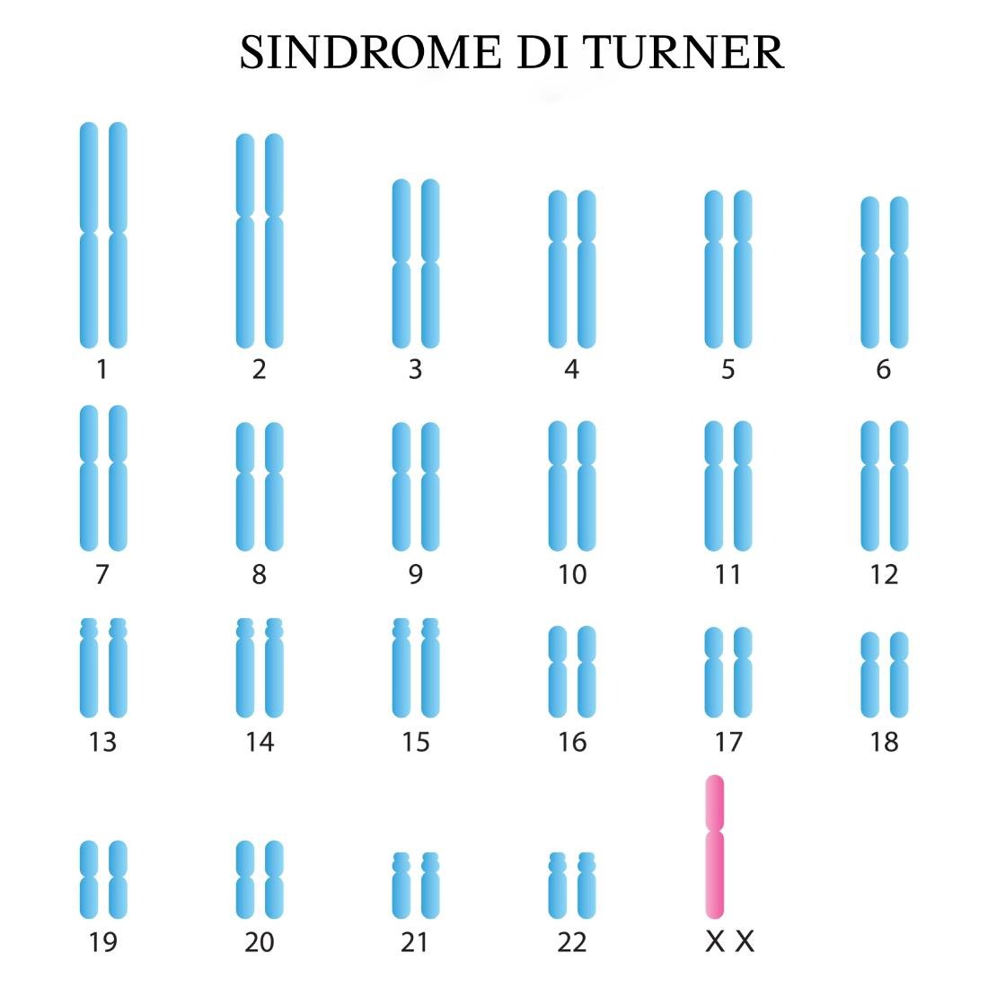 Sindrome di Turner