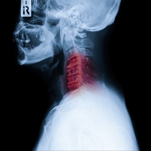 Anomalie della giunzione cranio-cervicale