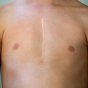 Deiscenza della ferita sternotomica