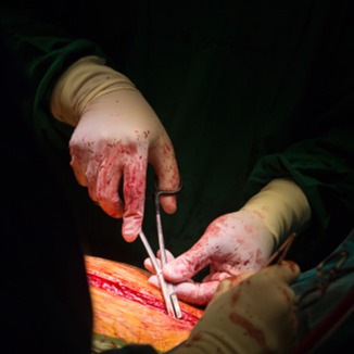 Deiscenza della ferita sternotomica