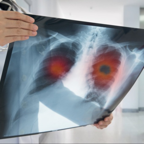Neoplasie della parete toracica