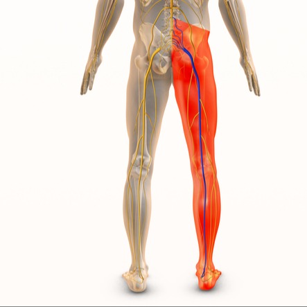 Schiacciamento vertebre (sciatica)