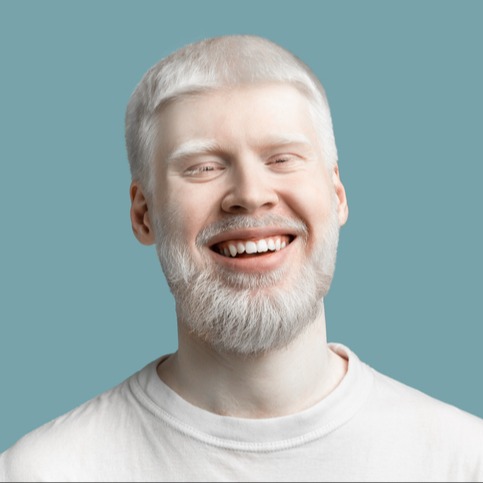 Albinismo