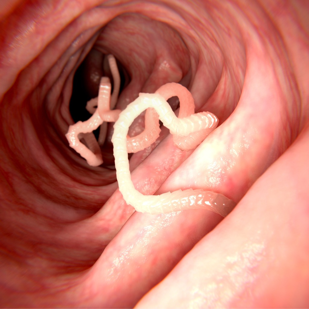 Cisticercosi