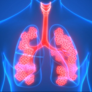 Edema polmonare