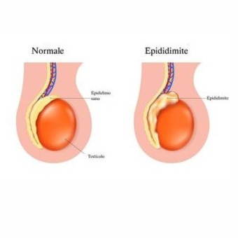 Epididimite