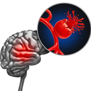 Ischemia cerebrale