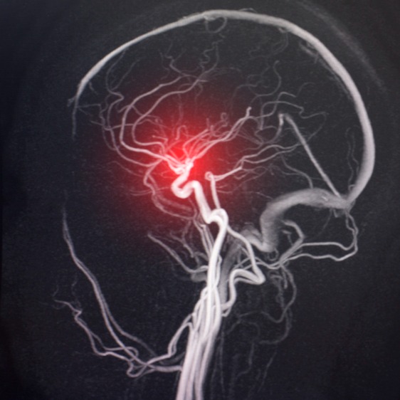 Ischemia cerebrale