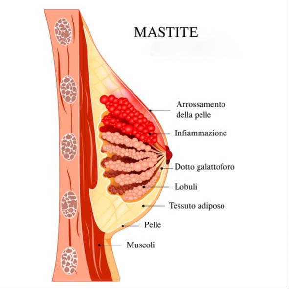 Mastite