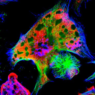 Neuroblastoma