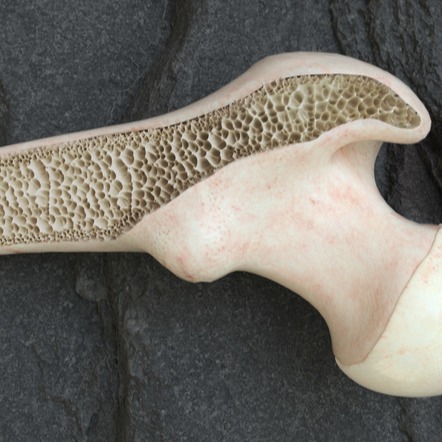 Osteopetrosi
