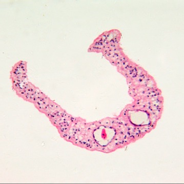 Schistosomiasi