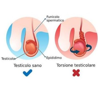 Torsione testicolare